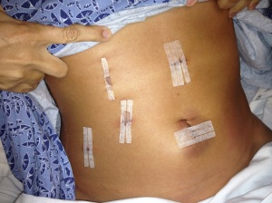 Five more incisions/scars added to my belly.